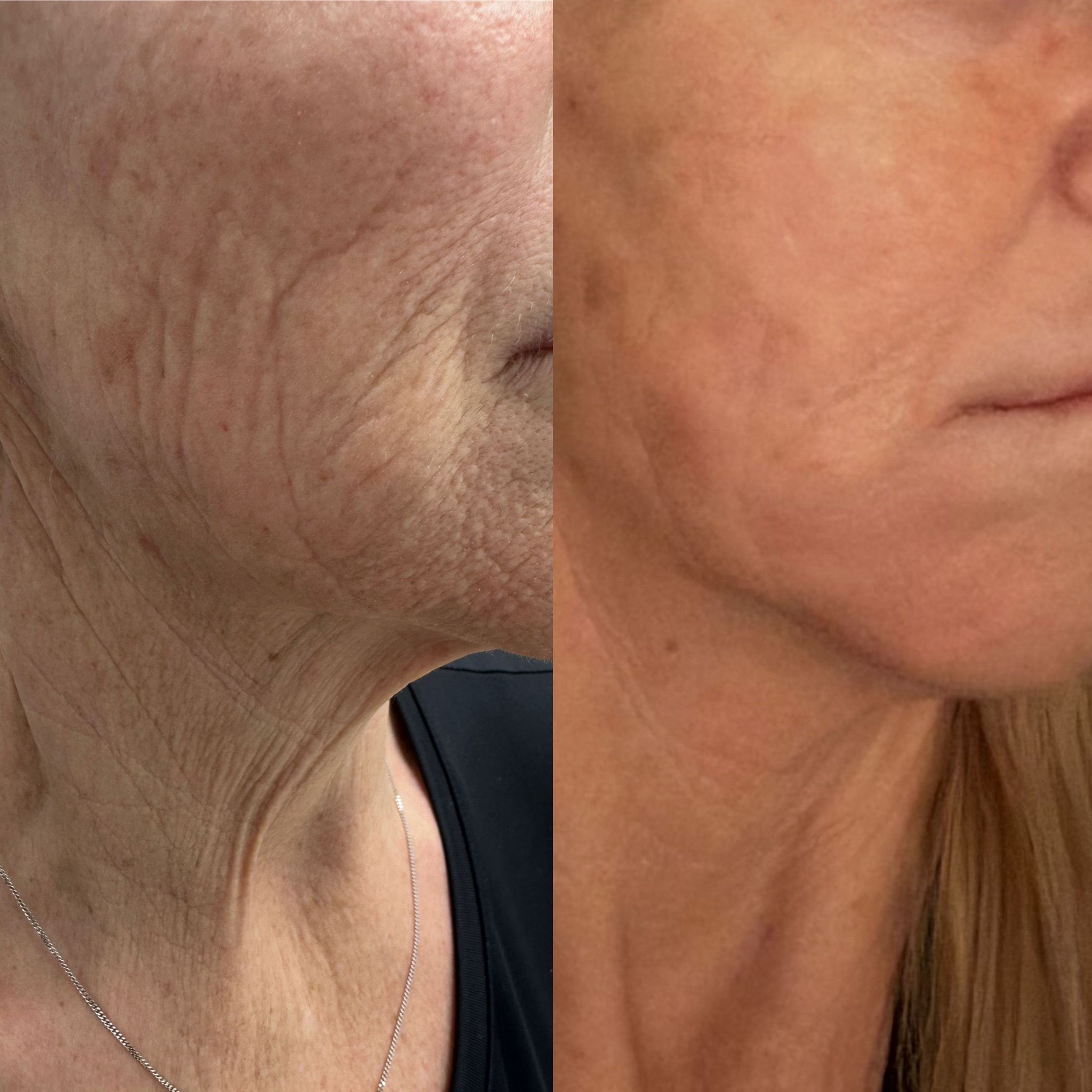 Wrinkle & Skin Rejuvenation