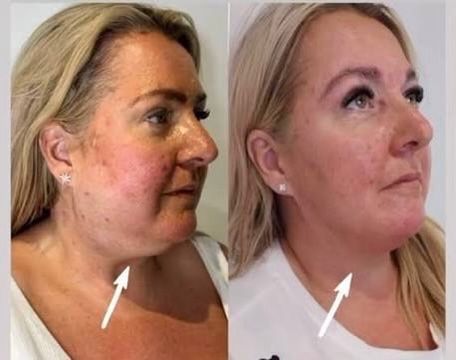 Jowl Reduction & Lift