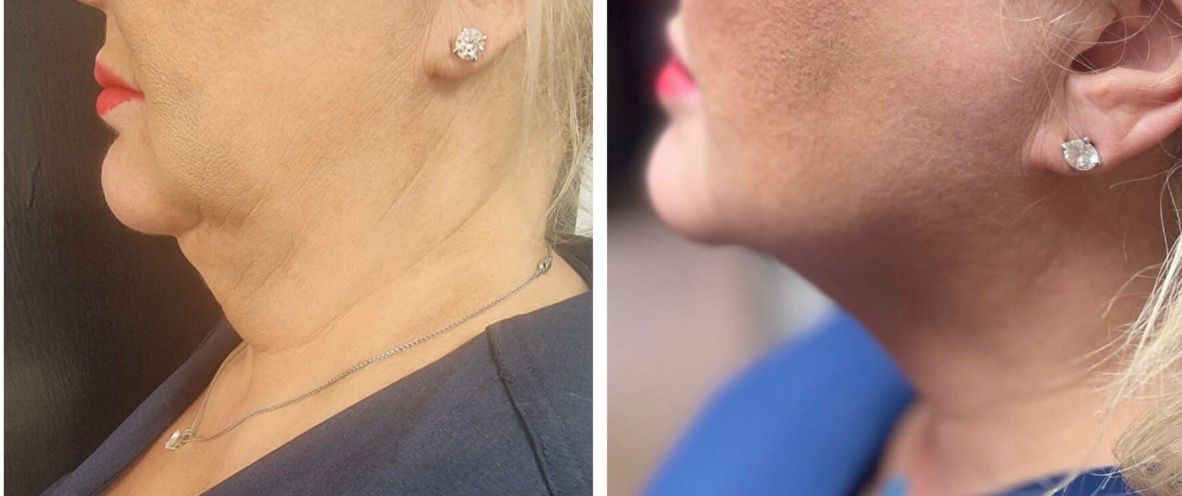 Neck Tightening